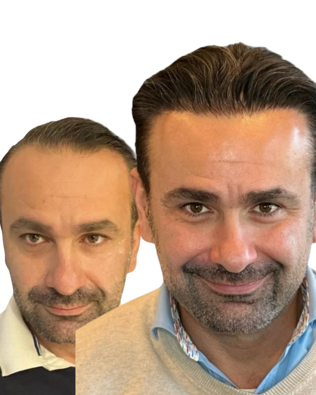 Sapphire FUE before/after