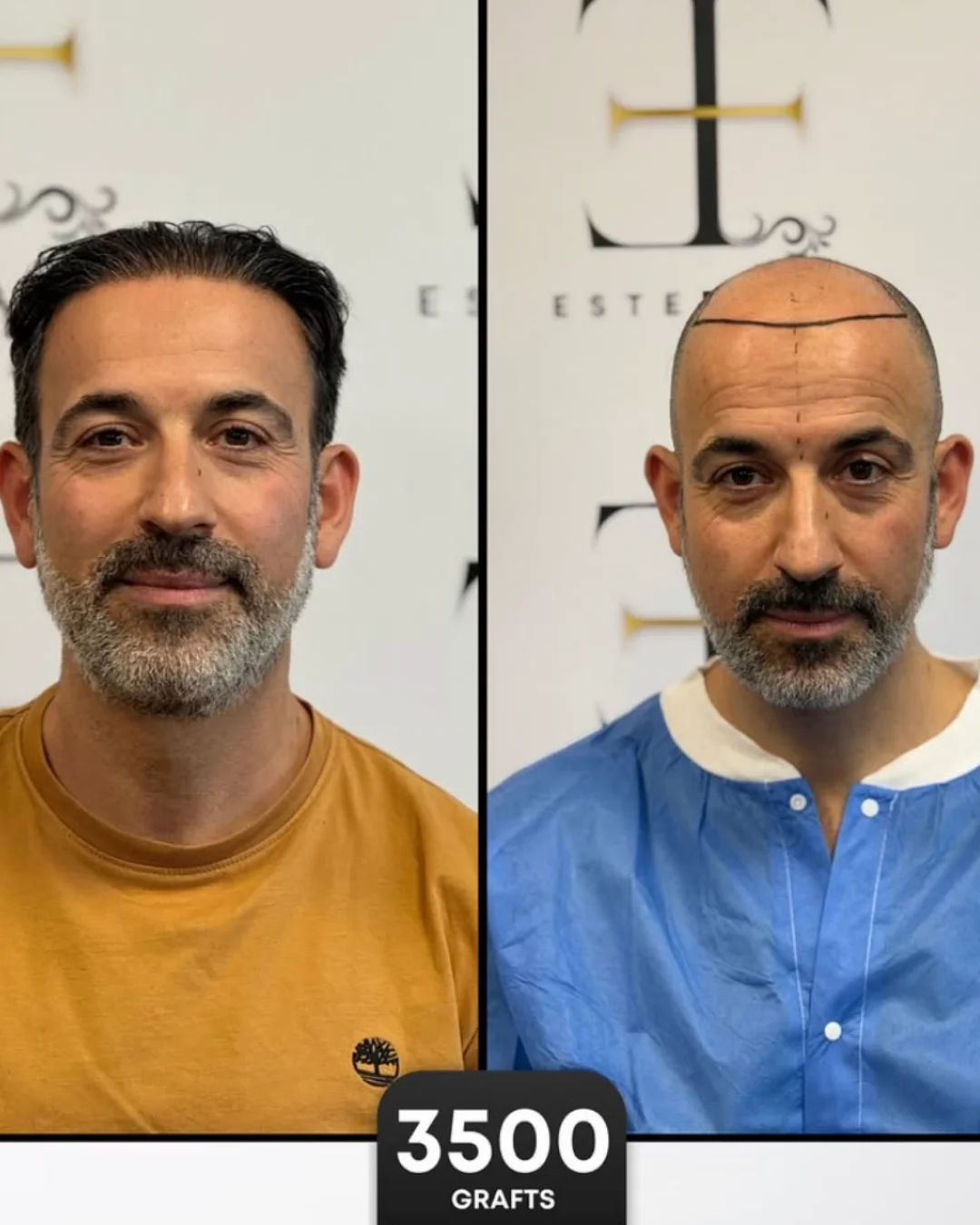 DHI Hair Transplant before/after
