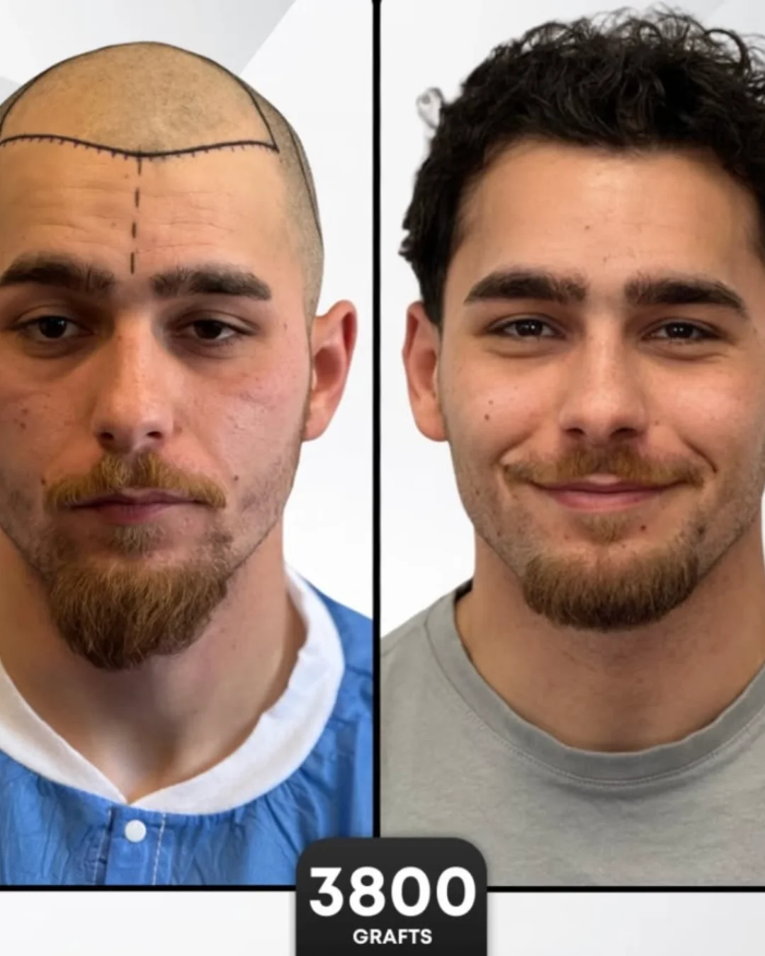 DHI Hair Transplant before/after