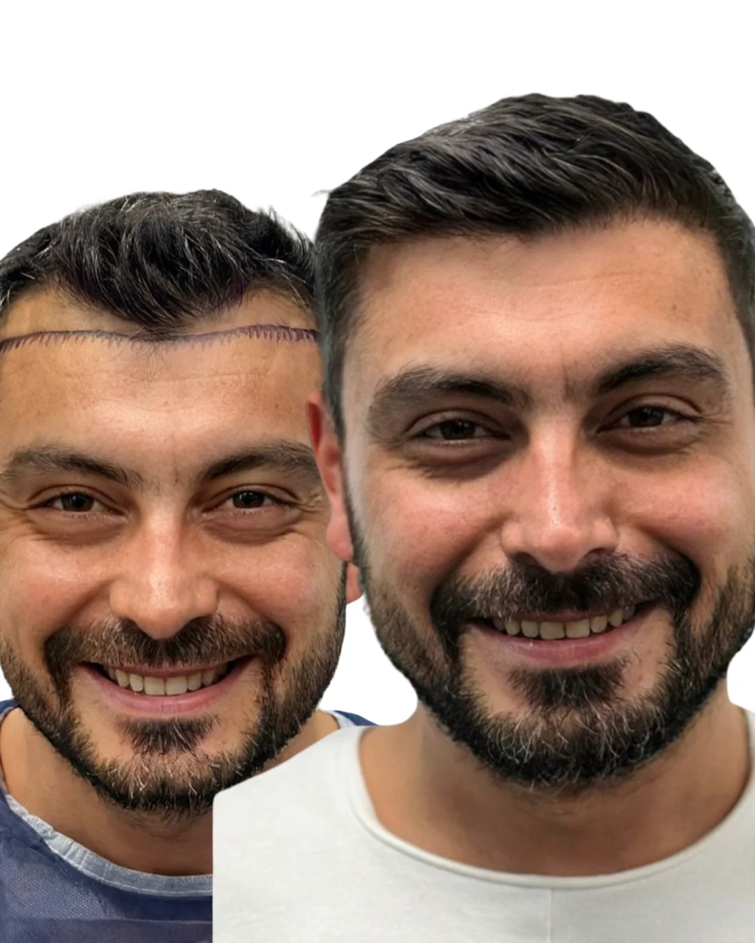 DHI Hair Transplant before/after