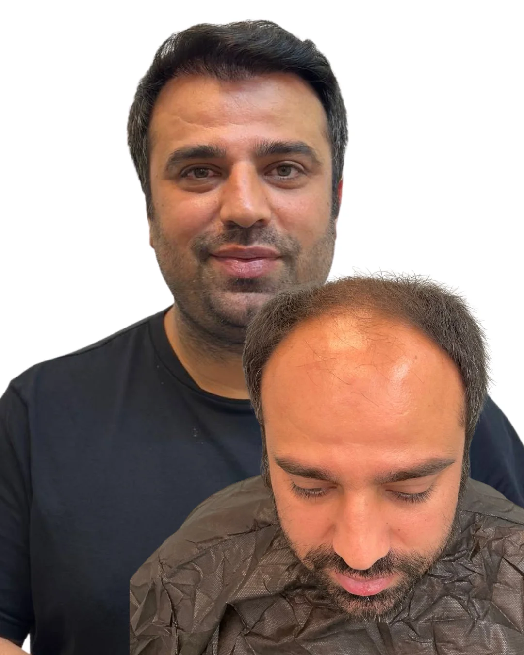 DHI Hair Transplant before/after